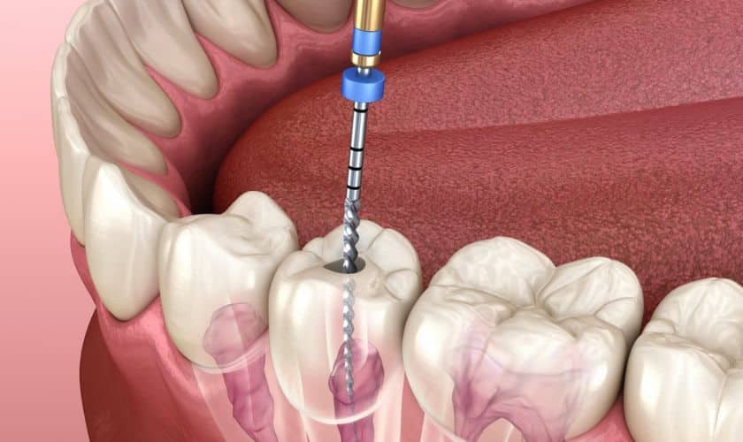Root Canals in South Austin TX