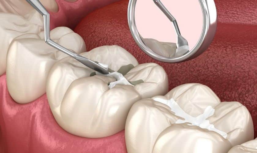 Dental Fillings in Austin TX, Dental Fillings in Austin, Dental Fillings in TX, Dentist TX