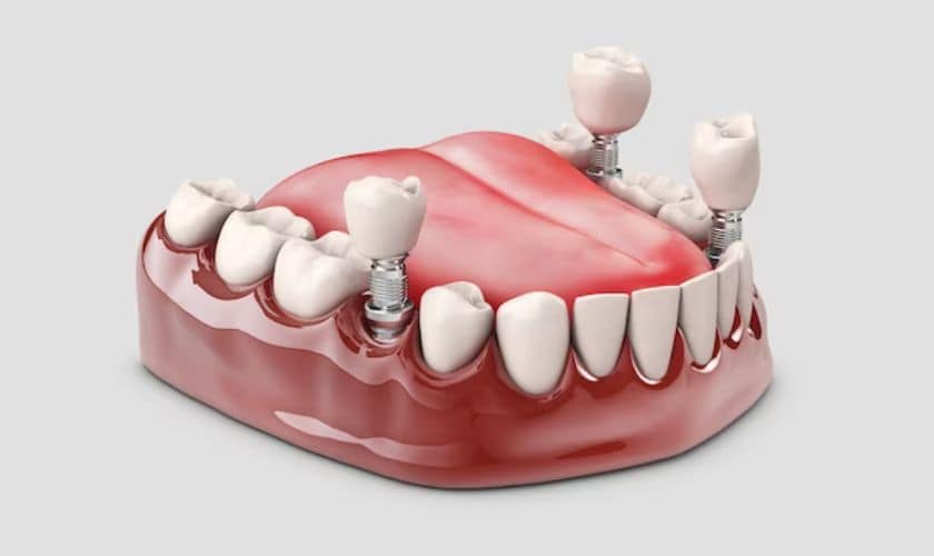 Dental Implants in South Austin TX