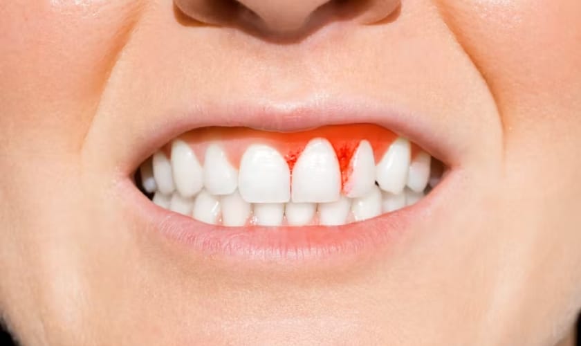 Best Toothpaste For Gum Disease
