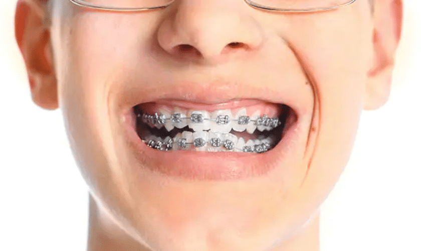 Do Braces Change Your Face Shape? 