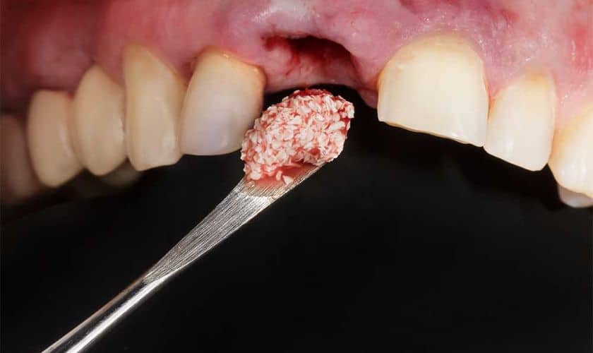 How Long Does it Take for Dental Bone Graft to Heal?