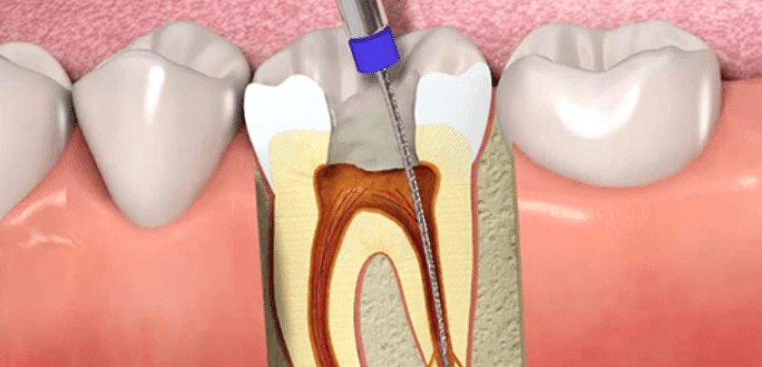 What To Expect After A Root Canal?