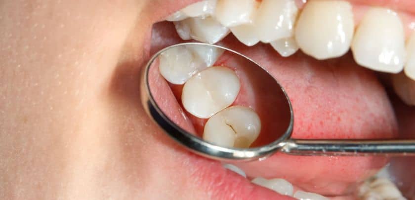 How Long Until The Cavity Becomes A Root Canal