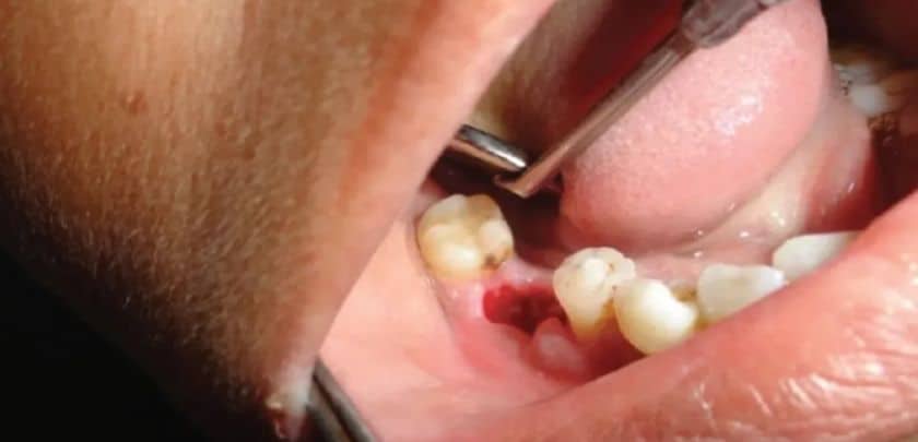 Why Does My Jaw Hurt Long After Tooth Extraction?