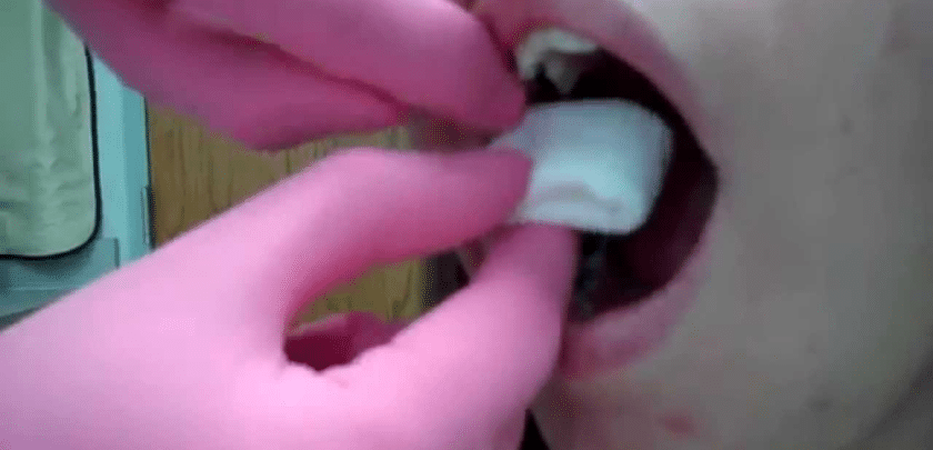 Tooth Extraction Bleeding