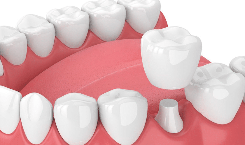 How Should I Care for a New Dental Crown