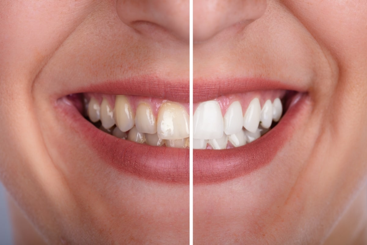 teeth-whitening-in-Austin-TX