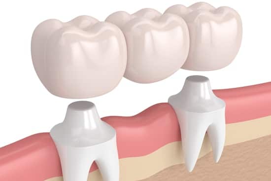 Dental crowns in South Austin placed over implants to restore missing teeth and improve function