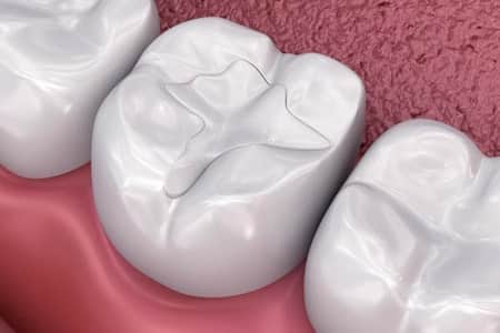 Dental filling procedure repairing a cavity in a molar tooth in South Austin, TX
