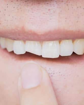 Chipped front tooth before dental filling repair in South Austin, TX