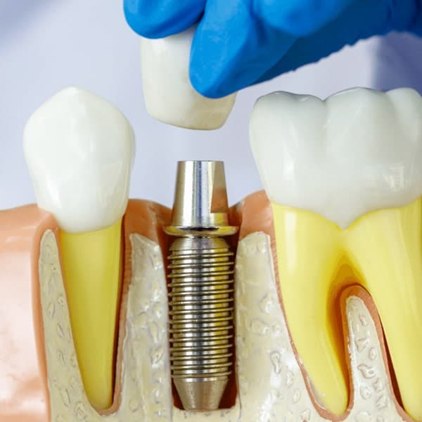 Dental implant post and crown placement in South Austin dental clinic
