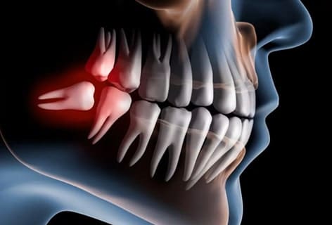 X-ray illustration of impacted wisdom tooth causing jaw pain during wisdom tooth removal treatment in South Austin, TX