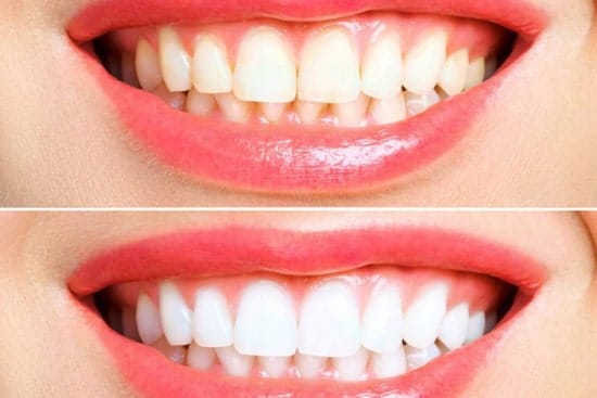 Before and after teeth whitening results in South Austin at Daylight Dental